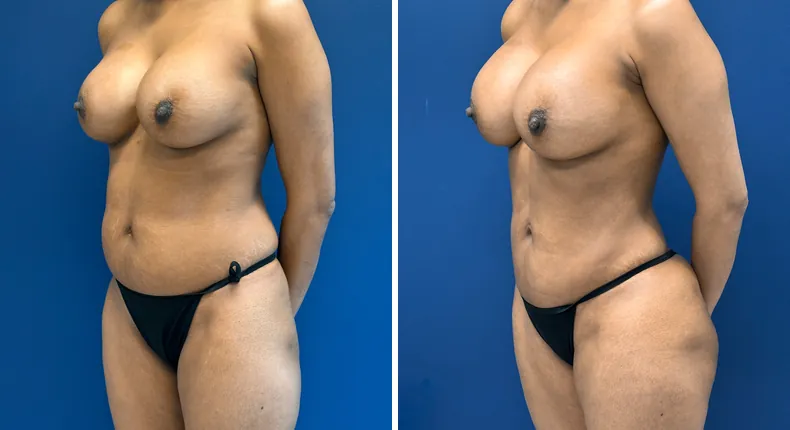 Before and after liposuction: patient's body from the left side