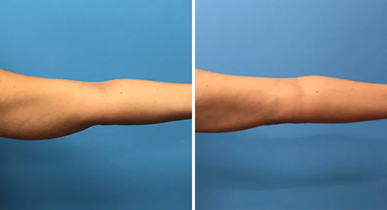 Before and after liposuction: woman's body