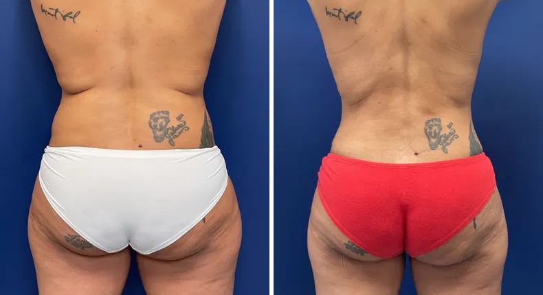 Before and after liposuction: patient's body from the back