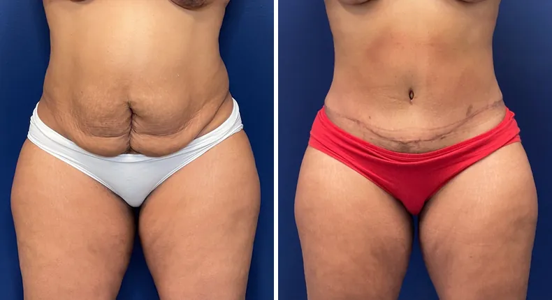 Before and after liposuction: patient's body from the front