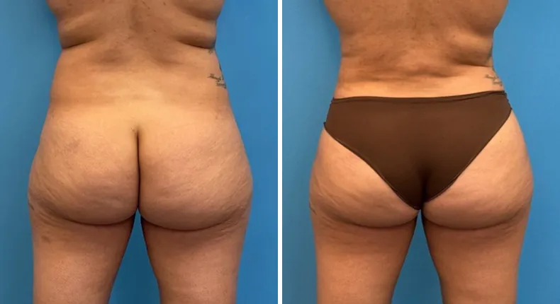 Before and after liposuction: woman's body from the back