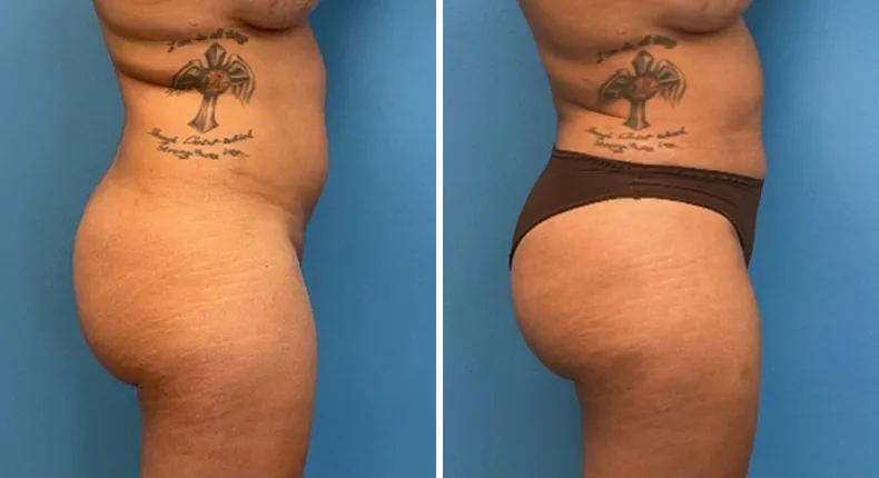 Before and after liposuction: woman's body from the right side