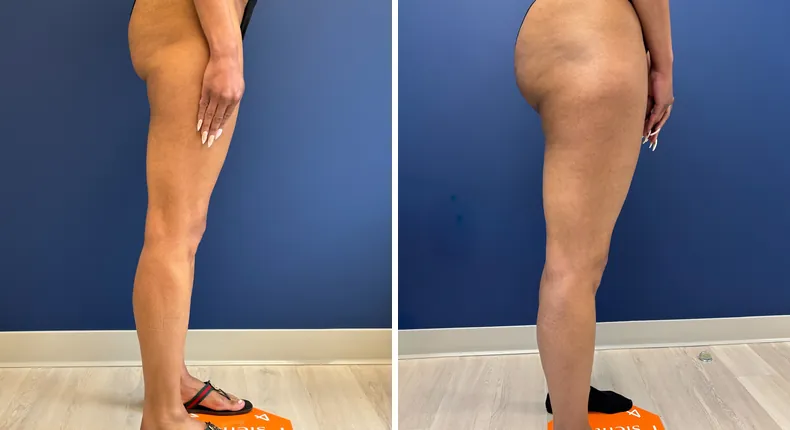 Before and after liposuction: patient's body from the right side
