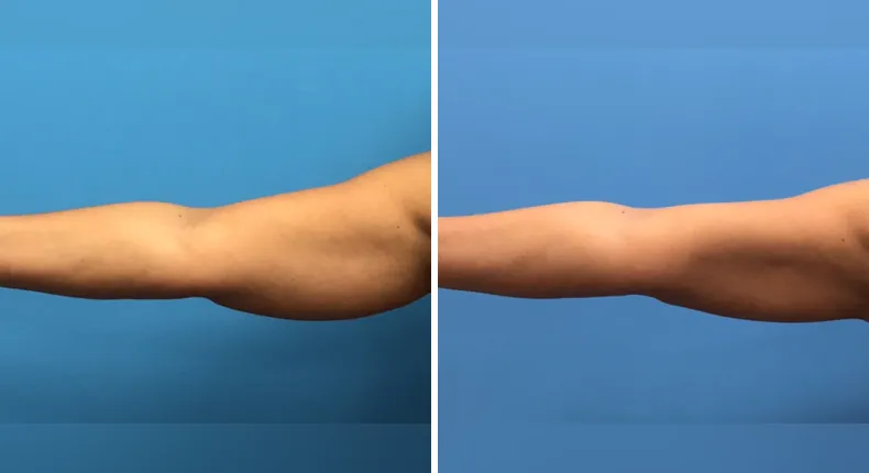 Before and after liposuction: patient's body from the back