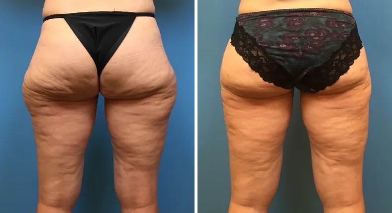Before and after liposuction: patient's body from the back