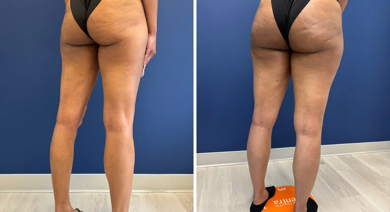 Before and after liposuction: patient's body from the right side
