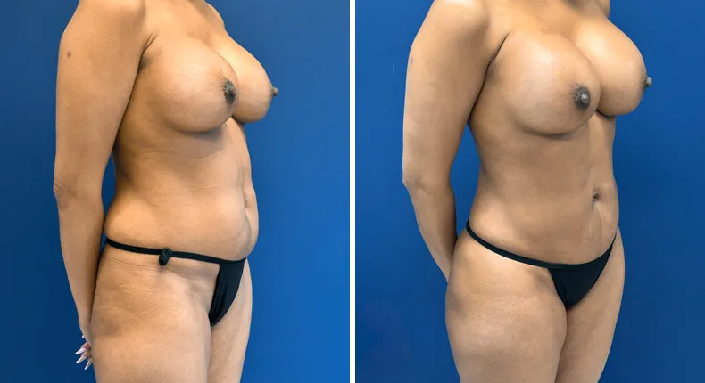 Before and after liposuction: patient's body from the right side