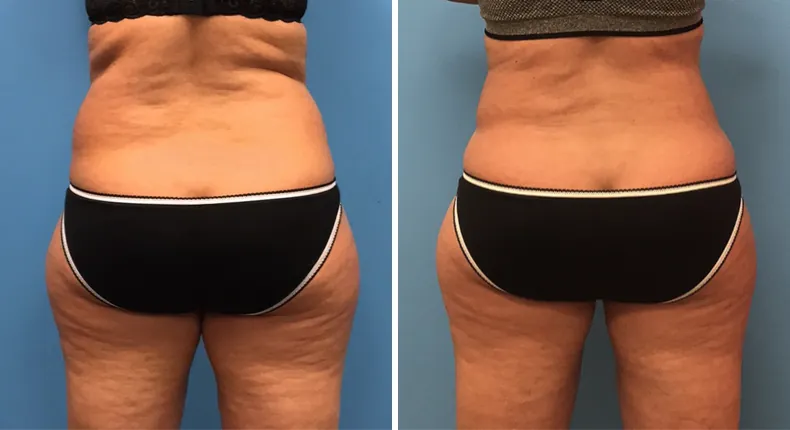 Before and after liposuction: woman's body from the back
