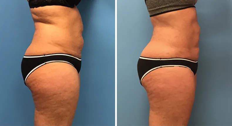 Before and after liposuction: woman's body from the right side