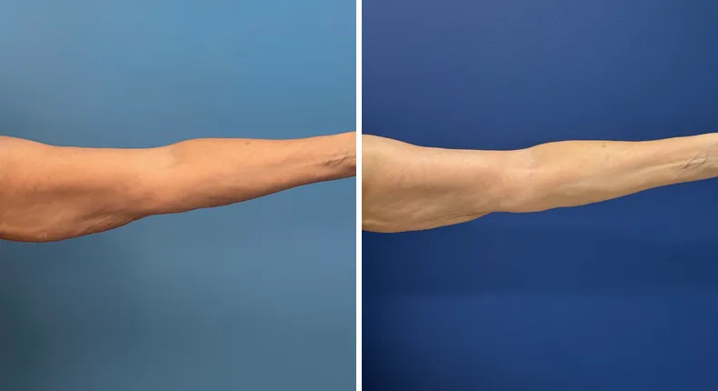 Before and after liposuction: patient's body from the front
