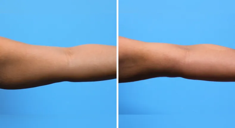 Before and after liposuction: patient's body from the right side