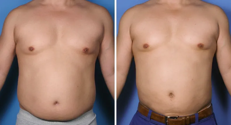 Before and after liposuction: patient's body from the front