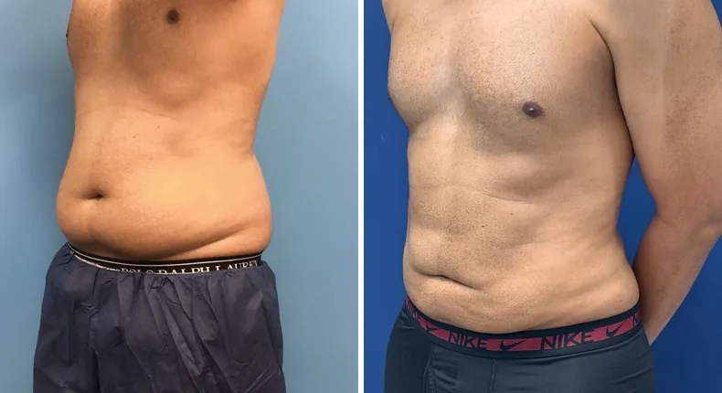 Before and after liposuction: man's body from the left side