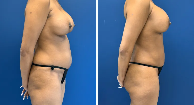 Before and after liposuction: patient's body in right profile