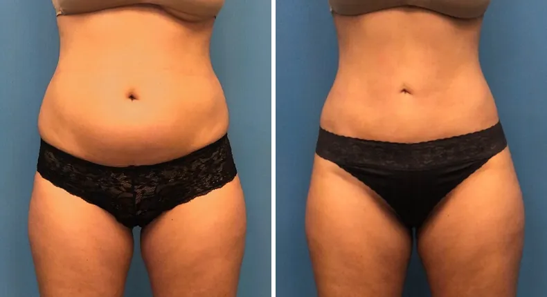 Before and after liposuction: patient's body from the front