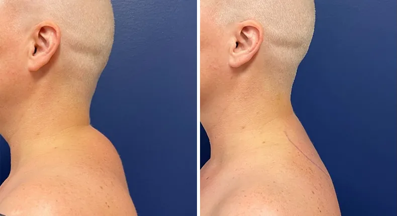 Before and after liposuction: patient's body