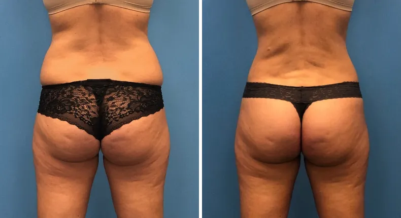 Before and after liposuction: patient's body from the back