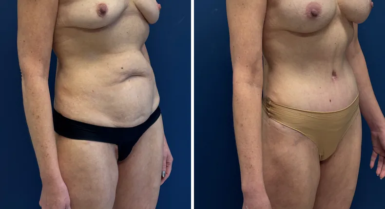 Before and after liposuction: patient's body at a right angle