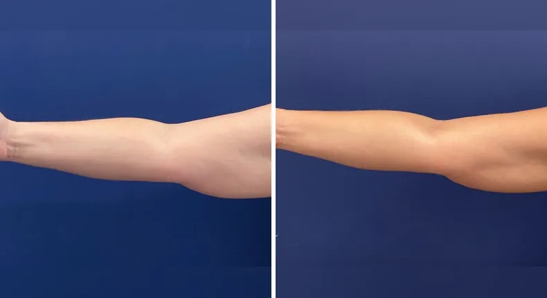 Before and after liposuction: patient's body from the left side