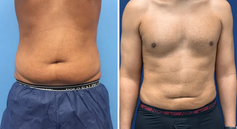 Before and after liposuction: man's body