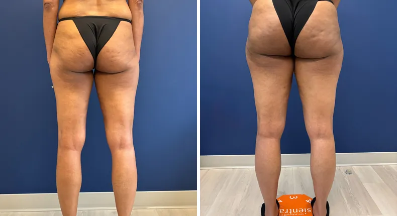 Before and after liposuction: patient's body