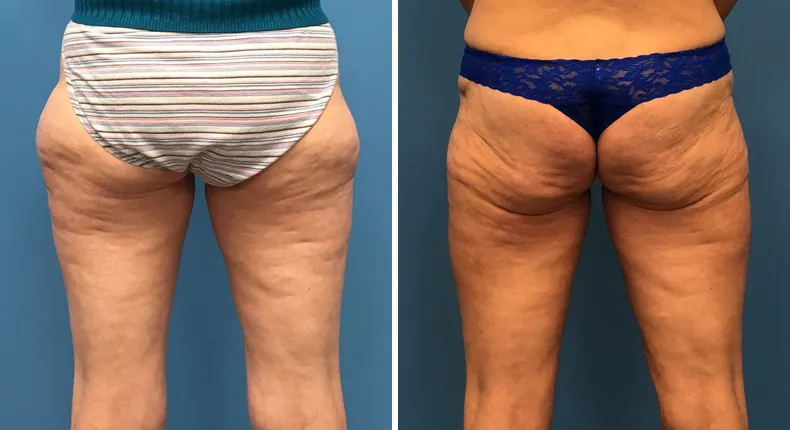 Before and after liposuction: woman's body
