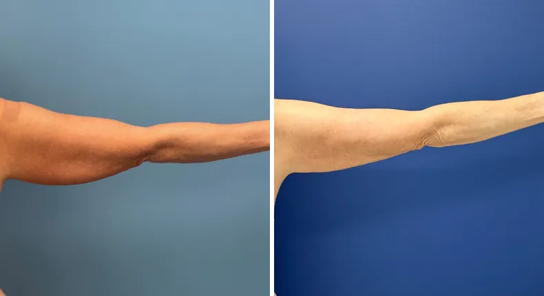 Before and after liposuction: patient's body from the back