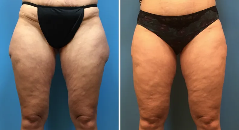 Before and after liposuction: patient's body from the front