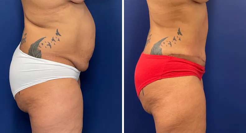 Before and after liposuction: patient's body from the right side