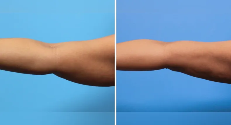 Before and after liposuction: patient's body from the left side