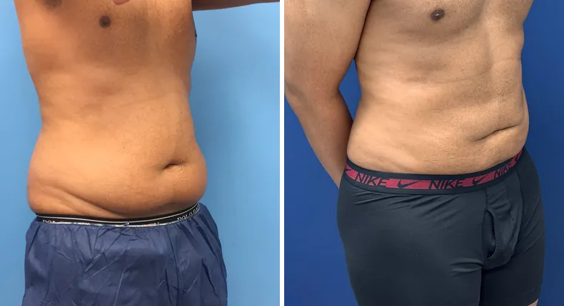Before and after liposuction: man's body from the right side