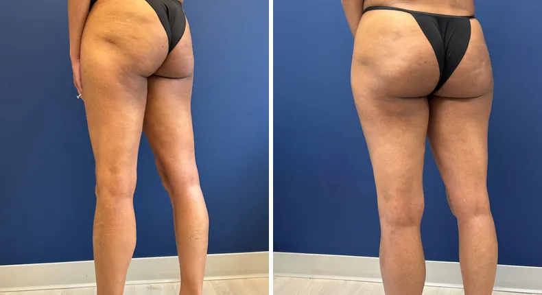 Before and after liposuction: patient's body from the left side