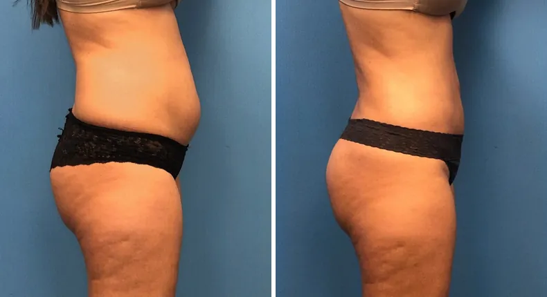 Before and after liposuction: patient's body from the right side