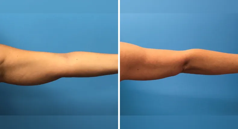 Before and after liposuction: patient's body from the front
