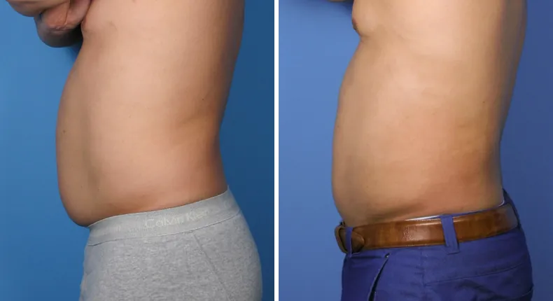 Before and after liposuction: patient's body from the left side