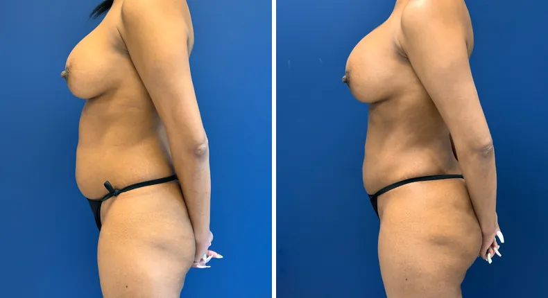 Before and after liposuction: patient's body in left profile