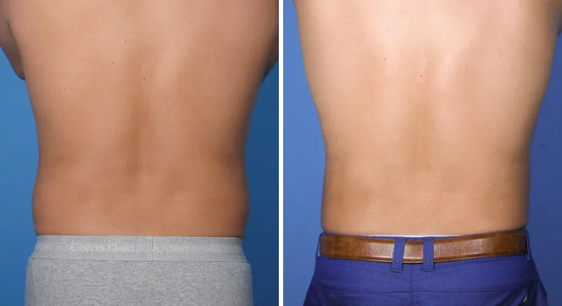 Before and after liposuction: patient's body from the back