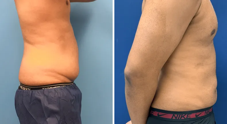 Before and after liposuction: man's body in right profile