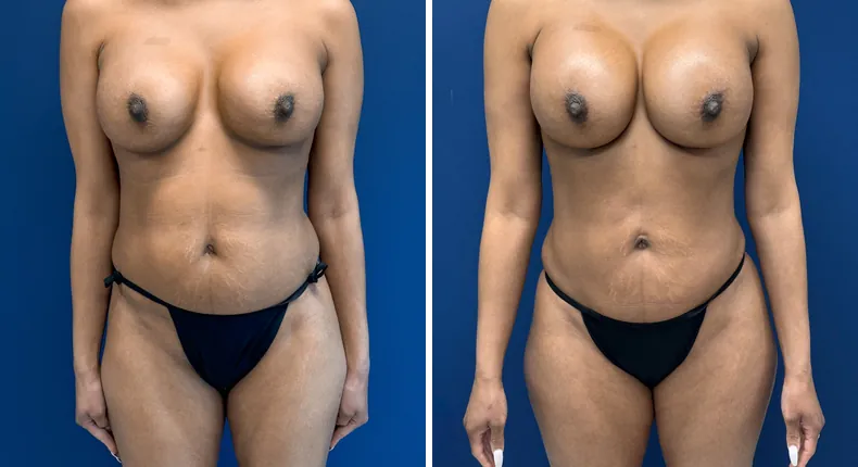 Before and after liposuction: patient's body