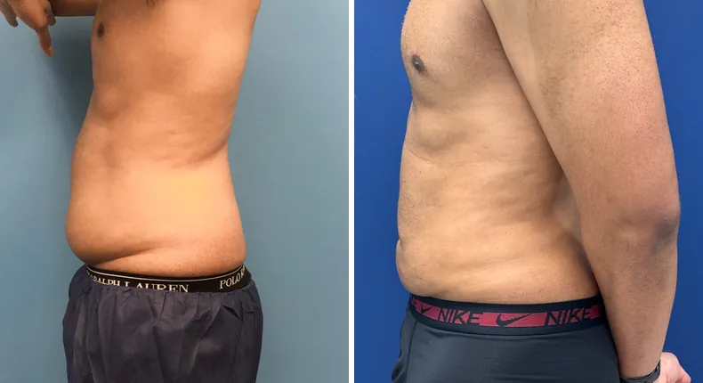 Before and after liposuction: man's body in left profile