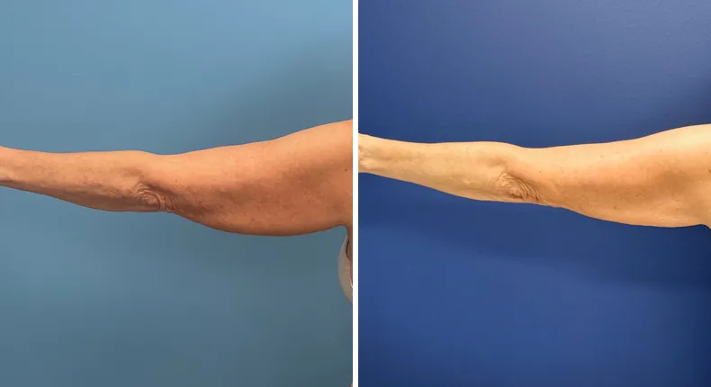 Before and after liposuction: patient's body from the back