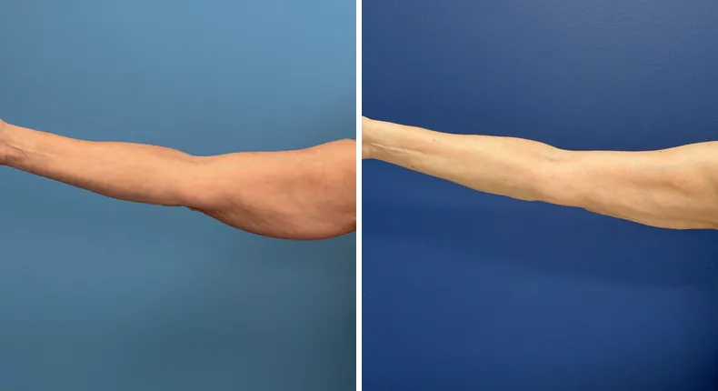 Before and after liposuction: patient's body from the front