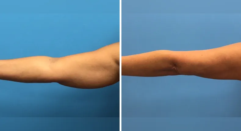 Before and after liposuction: patient's body from the front