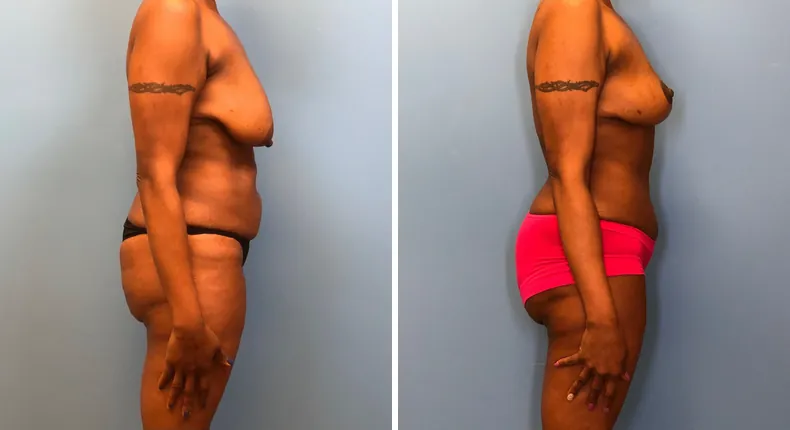 Before and after mommy makeover: woman's body from the right side