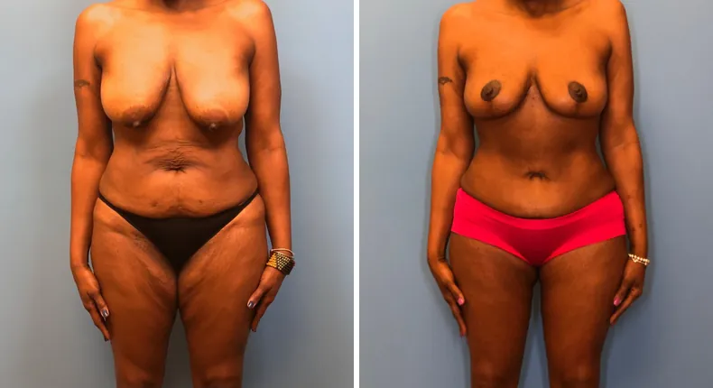 Before and after mommy makeover: woman's body from the front