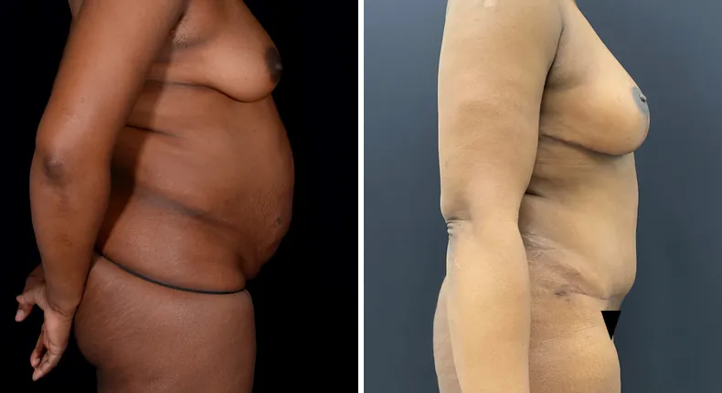 Before and after mommy makeover: patient's body from the right side