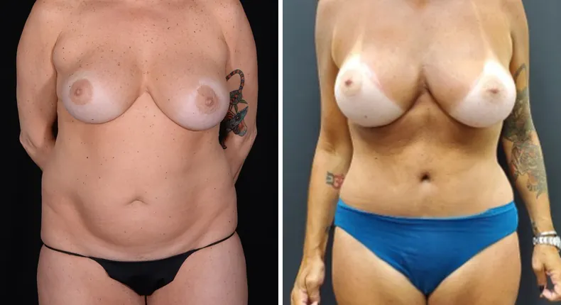 Before and after mommy makeover: woman's body from the front