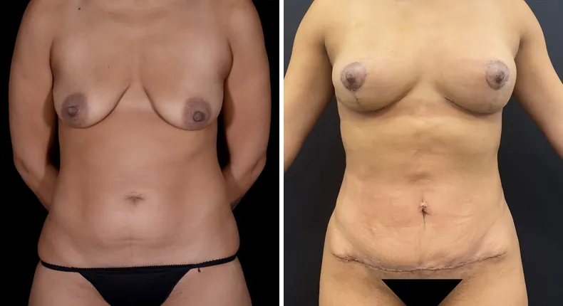 Before and after mommy makeover: woman's body from the front