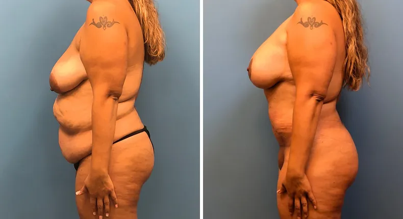 Before and after mommy makeover: woman's body from the left side
