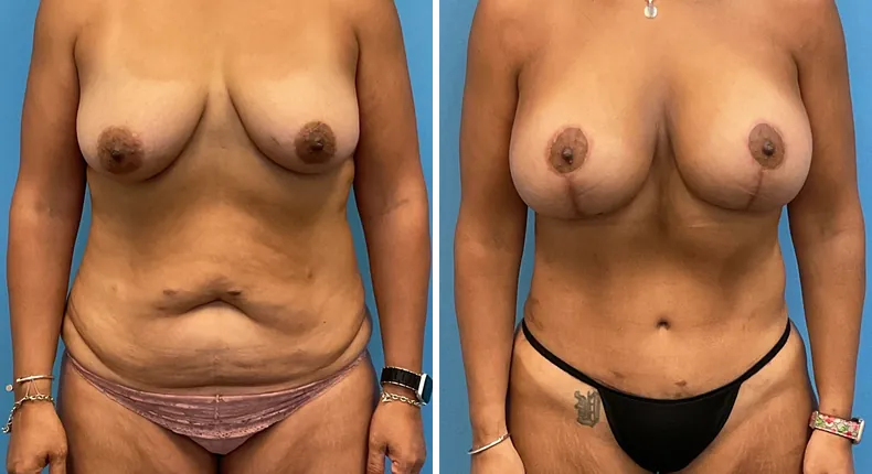 Before and after mommy makeover: woman's body from the front